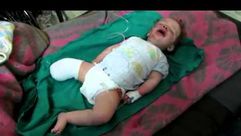 سورية - طفلة فقدت ساقها في إدلب