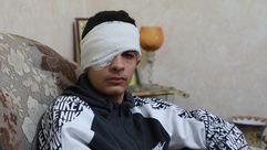 طفل فلسطيني فقد عينه برصاص الاحتلال- الأناضول