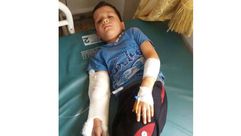 طفل سوري أصيب في مخيم الزوف للنازحين ريف إدلب بعد قصفه من النظام بطائرة مسيرة