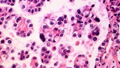 خلايا سرطان المبيض - جيتي