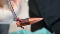 طلقة قناص استخرجها الطبيب من جسد أحد الأطفال في غزة- سي بي أس