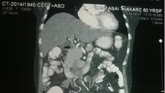 صورة اشعة وزعها قسم الجراحة في مستشفى ناغبور لرفات الجنين داخل امه في 25 اب/اغسطس 2014