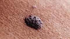الشامات والسرطان سرطان الجلد