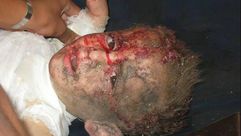سراقب - طفل مصاب - غارات جوية لطئرات النظام السوري 21-9-2014