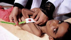 اليمن طفل سوء تغذية