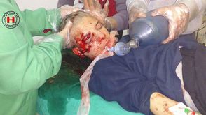 طفل مصاب في المعضمية - الغوطة الغربية - سوريا
