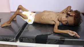 طفل يمني يعاني من سوء التغذية ينتظر العلاج - جيتي