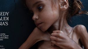 طفلة يمنية تتضور جوعا