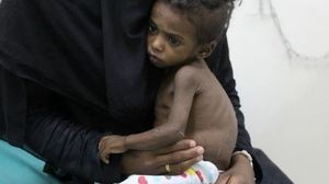 الأمم المتحدة: المناطق الأكثر تضررا في أبين ولحج وتعز ويعاني فيها طفلٌ واحد من كل 5 أطفال من سوء التغذية الحاد- الأناضوب