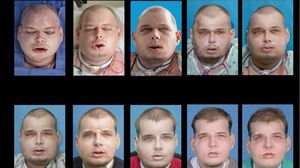 مجموعة صور تظهر تطور عملية زرع وجه بالكامل للمريض باتريك هارديسون - أ ف ب