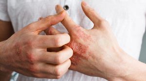 يعد التهاب الجلد التأتبي مرضا وراثيا نسبيا- أرشيفية
