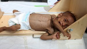 2.5 مليون طفل يعاني من سوء التغذية- جيتي
