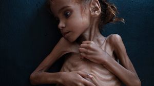 وفاة أمل الفتاة اليمنية التي تعد وجه المعاناة في الحرب اليمنية- نيويورك تايمز