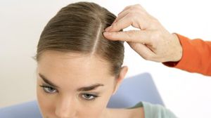 قشرة الرأس هي مرض جلدي يؤثر على فروة الرأس ويمكن أن يكون مزعجا للغاية- جيتي 