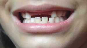 حموضة الفم التي تظهر في أثناء النوم أو الاستلقاء تشكل خطرا كبيرا وتضعف مينا الأسنان- جيتي