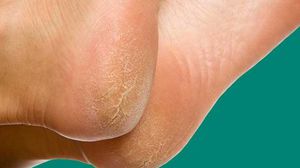 طبقة الجلد السميكة تتكون لحماية القدم من الضرر نتيجة الضغط والاحتكاك- تويتر