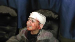 أحد الأطفال المصابين في القصف على دوما اليوم الاثنين