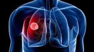 سرطان الرئة يتم الكشف عنه عن طريق تصوير مقطعي وغالبا ما يكون ذلك نتيجة لاضطرابات في التنفس مشبوهة