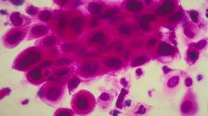 النتائج تشير إلى أن امبورتين-11 يعد عاملا أساسيا لعملية نمو خلايا سرطان القولون والأمعاء- جيتي