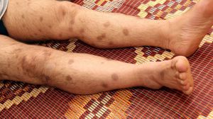 آثار تعذيب على أقدام سوريا - (أرشيفية) الأناضول