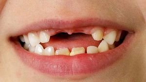 تسوس الأسنان يتسبب في الإصابة بالخُراج والالتهابات وأمراض الفم الأخرى - أرشيفية