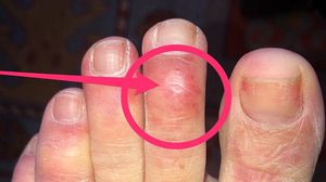  "أصابع كوفيد" قد يكون من علامات الإصابة بعدوى فيروس كورونا المستجد- بزنس انسايدر