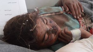 طفلة مصابة بشظايا شوهت وجهها - فيديو بثته وكالة أعماق