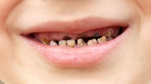  الصور الجرافيكية للأسنان المدمرة والتحذيرات الصحية على المشروبات السكرية ساعدت الشباب في اختيار خيارات صحية