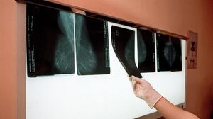 صور ماموغرام تكشف عن سرطان الثدي - أ ف ب