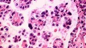 الغارديان: يأمل الباحثون أن تصبح اختبارات الخلايا السرطانية جزءا من أداة "الفحص الشامل"- جيتي