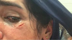 الصحفية شذى حماد أصيبت بوجهها بشظايا قنبلة غاز ألقيت باتجاهها- عربي21
