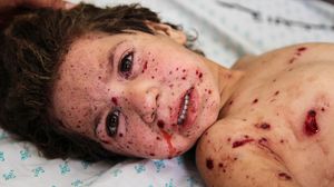 طفل فلسطيني مصاب بشظايا القذائف الإسرائيلية - الأناضول