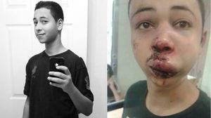 الفتى طارق ابو خضير ويظهر عليه آثار تعذيب الشرطة الاسرائيلية - فيس بوك