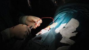 أطباء يجرون عملية جراحية على ضوء الهواتف المحمولة جراء أزمة الكهرباء بمصر - أرشيفية