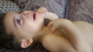 أحد أطفال الزبداني يعاني من سوء التغذية والمرض - عربي21