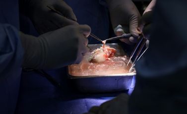جراحون من مستشفى "ماساتشوستس جنرال هوسبيتال" في بوسطن يتولون إعداد كلية خنزير معدل وراثي قبل زرعها لمريض بشري حي في 16 آذار/مارس 2024.