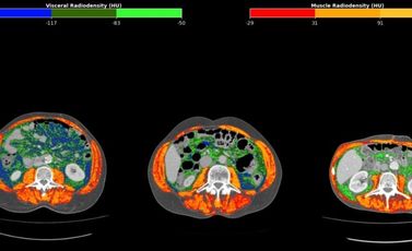 image-01-ct-gastric-cancer
