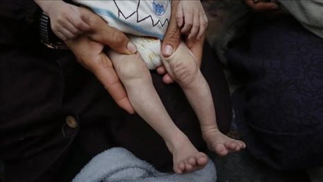 الجوع والمرض ينهش جسد الرضيعة جنيد في شمال قطاع غزة