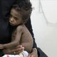 اليمن اطفال سوء تغذية الاناضول
