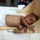 اليمن مجاعة معاناة حرب - جيتي