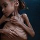 الطفلة اليمنية أمل حسين - نيويورك تايمز