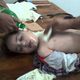 طفلة مصابة بالأسلحة الكيماوية - كفر بطنا - ريف دمشق - سورية 20-8-2013