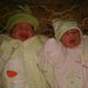 ولادة ثلاثة توائم - الغوطة الشرقية المحاصرة - سوريا