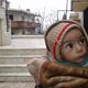 طفل يعاني من سوء التغذية - مضايا المحاصرة - ريف دمشق - الزبداني