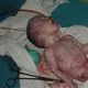 طفل حديث الولادة - جنين مشوه في حلب بسبب الغازات السامة - سوريا