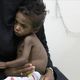 اليمن مجاعة فقر امراض الاناضول
