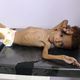 طفل يمني يعاني من سوء التغذية ينتظر العلاج - جيتي